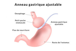 pose anneau gastrique lille prix